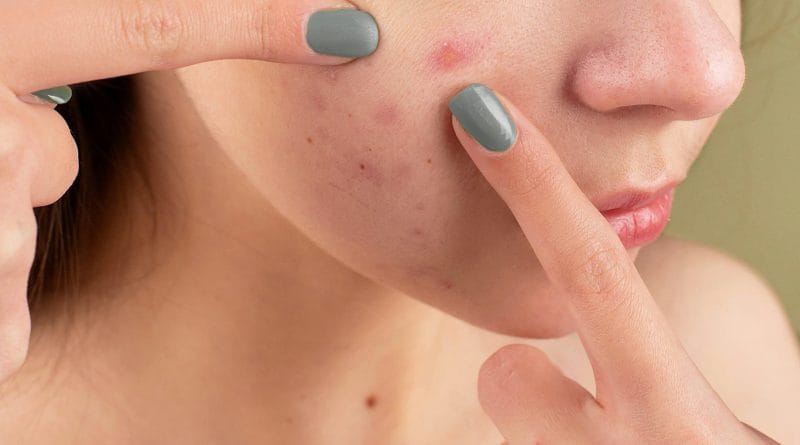Pielęgnacja cery trądzikowej